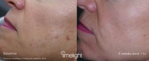 IPL Limelight Photofacial Before after Charlotte, NC