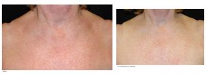 Laser Dermatology IPL Facial Charlotte, NC