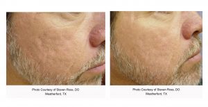 Laser Genesis Before and After in Charlotte, NC