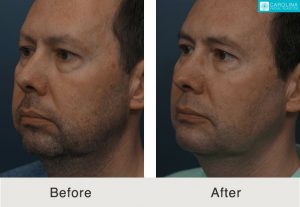 Buccal-fat-removal-chin-implant-for-jawline-contouring-Kulbersh-1