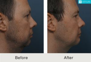 Buccal-fat-removal-chin-implant-for-jawline-contouring-Kulbersh-2