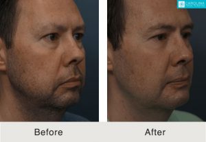 Buccal-fat-removal-chin-implant-for-jawline-contouring-Kulbersh-3