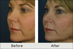 revision rhinoplasty before and after results in charlotte, NC