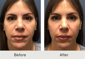 under eye dermal fillers in charlotte, nc