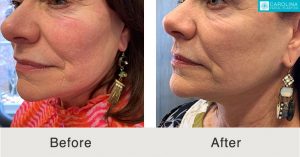 daxxify for rosacea before and after