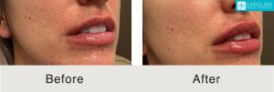 Restylane-Lyft-para-mejora de labios-Kulbersh-3