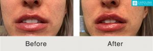 Restylane-Lyft-para-mejora de labios-Kulbersh