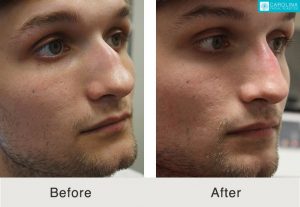Rinoplastia-para-enderezar-y-corregir-puente-nasal-Kulbersh-1