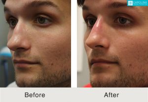 Rinoplastia-para-enderezar-y-corregir-puente-nasal-Kulbersh