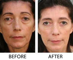 Lower Blepharoplasty results in Charlotte, NC