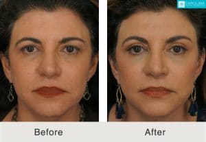 facelift for jawline sculpting in charlotte, nc