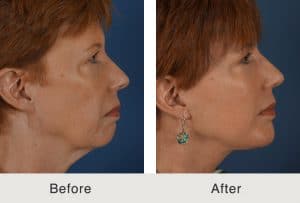 cirugía de estiramiento de la piel de estiramiento facial en charlotte, nc