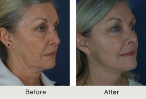 jawline sculpting results in charlotte, nc