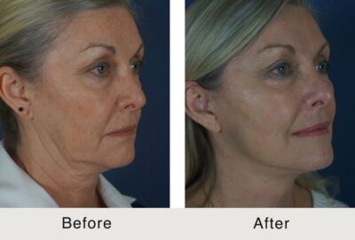 Female patient jawline contouring results before and after treatment in our Charlotte medspa