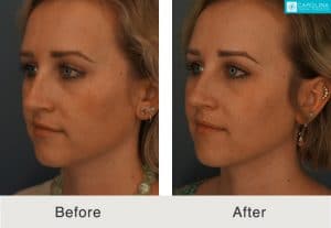 neck liposuction in charlotte, NC