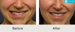 daxxify for asymmetrical smile before and after