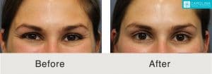 botox injections in Charlotte, NC