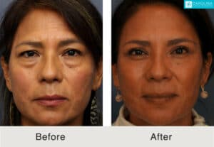 Ethnic-Lower-blepharoplasty-to-refresh-under-eyes-Kulbersh-Carolina