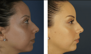 Antes-Después-30-yo-rinoplastia no quirúrgica