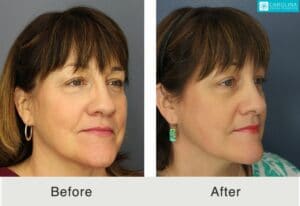 Profound-RF-microneedling-to-rejuvenate-lower-face-and-neck-Kulbersh-1