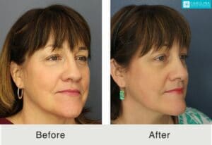 microneedling results on a female patient