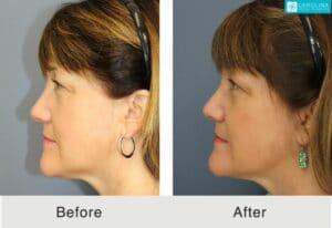 Profound-RF-microneedling-to-rejuvenate-lower-face-and-neck-Kulbersh-3