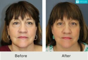 Profound-RF-microneedling-to-rejuvenate-lower-face-and-neck-Kulbersh-4