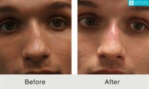 male rhinoplasty results in Charlotte, NC