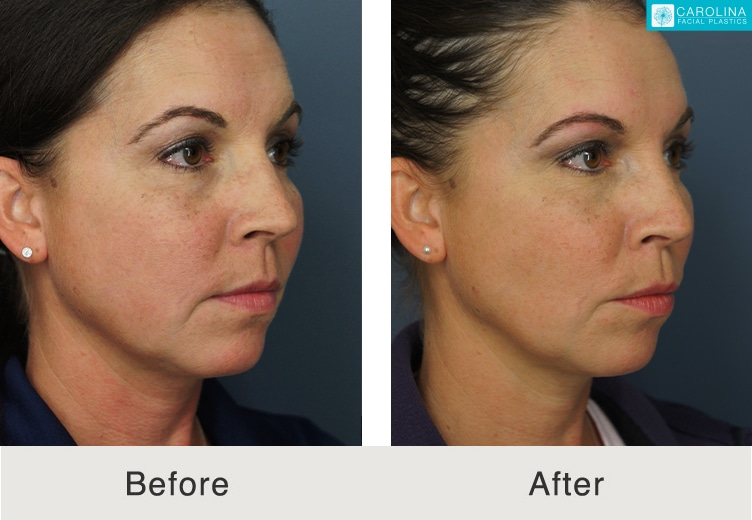 Buccal Fat Pad Reduction - Skinnovation Clinics