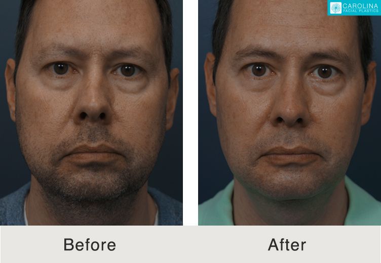 The Difference Between Buccal Fat Pad Removal and Cheek