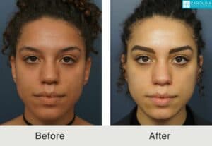 Ethnic-rhinoplasty-to-improve-the-nose-Kulbersh-Carolina