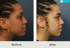 Ethnic-rhinoplasty-to-improve-the-nose-Kulbersh-Carolina-2