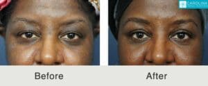 Upper-blepharoplasty-to-lift-lid-refresh-eyes-Carolina-Kulbersh-1