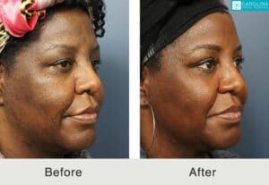 Upper-blepharoplasty-to-lift-lid-refresh-eyes-Carolina-Kulbersh-2