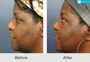 Upper-blepharoplasty-to-lift-lid-refresh-eyes-Carolina-Kulbersh-6