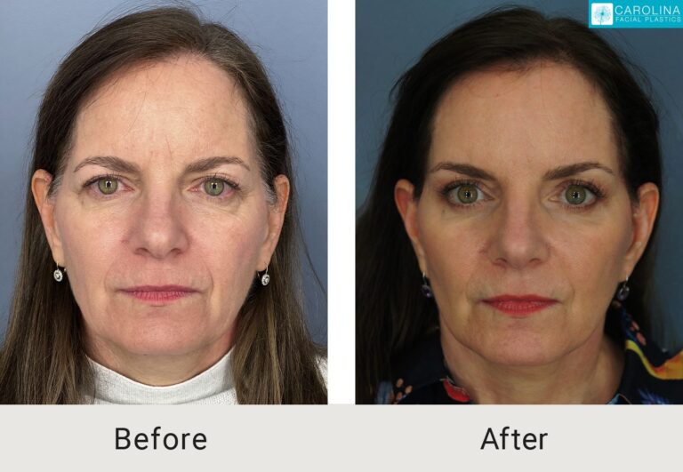 brow lift results on a female patient