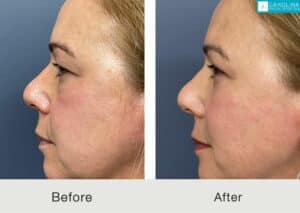 Brow-lift-quad-blepharoplasty-for-upper-face-rejuvenation-Kulbersh-Carolina-1