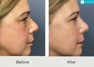 Brow-lift-quad-blepharoplasty-for-upper-face-rejuvenation-Kulbersh-Carolina-3
