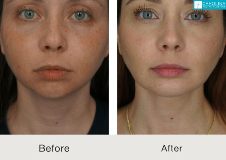buccal fat removal for chubby cheeks