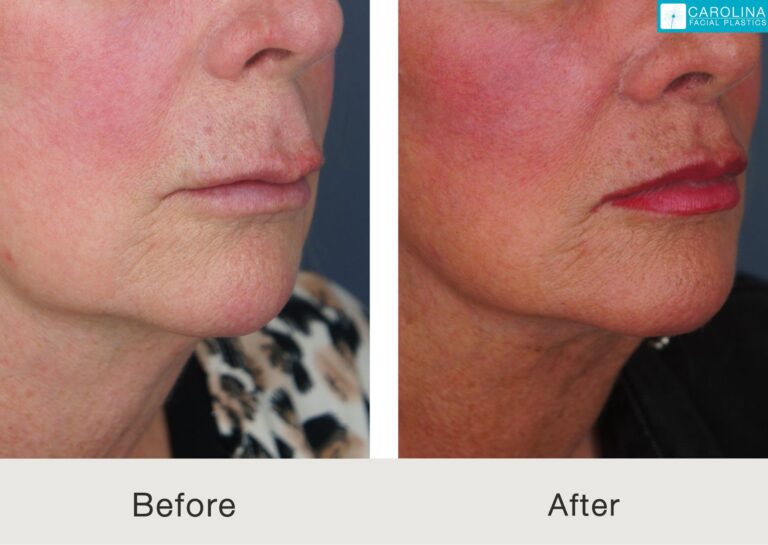 lip lift and a lower facelift before and after