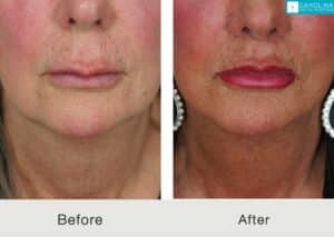 Lifting de labios-lifting-facial-inferior-lifting-de-cuello-para-rejuvenecimiento-facial-Kulbersh-Carolina