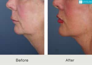 Lifting de labios-lifting-facial-inferior-lifting-de-cuello-para-rejuvenecimiento-facial-Kulbersh-Carolina-4