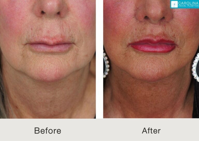 Neck lift and lip lift in Charlotte, NC