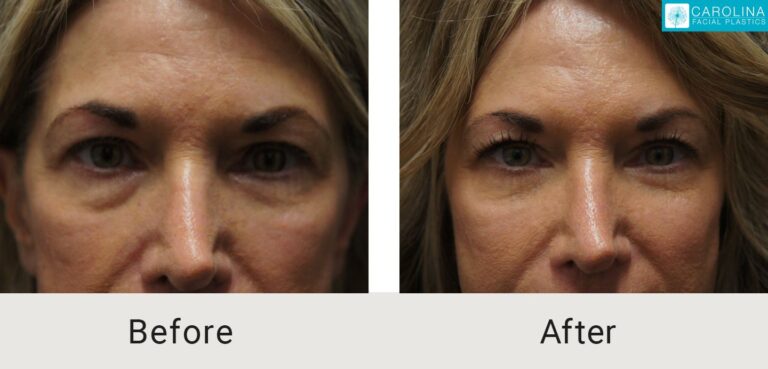 Lower Blepharoplasty to reduce eye bags in Charlotte