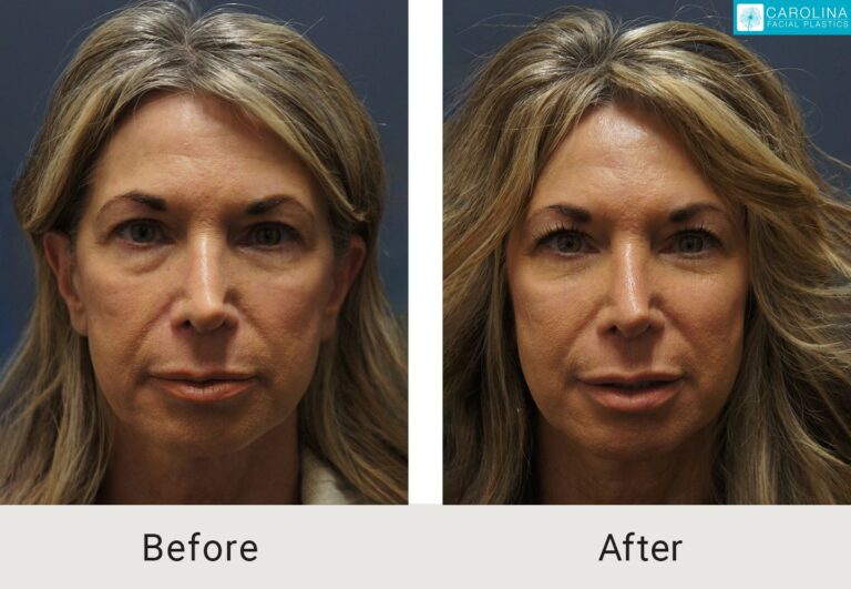 lower blepharoplasty results