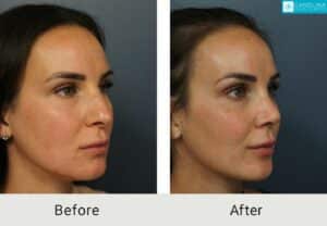 Rhinoplasty-to-improve-the-bridge-and-tip-Kulbersh-Carolina-5