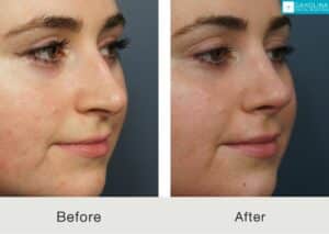 Septorhinoplasty-to-improve-nasal-form-and-function-Kulbersh-Carolina-1