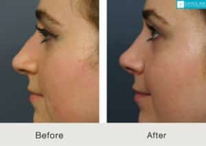 Septorhinoplasty-to-improve-nasal-form-and-function-Kulbersh-Carolina-3