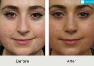Septorhinoplasty-to-improve-nasal-form-and-function-Kulbersh-Carolina