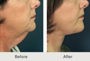 neck lift before and after results in Charlotte, NC